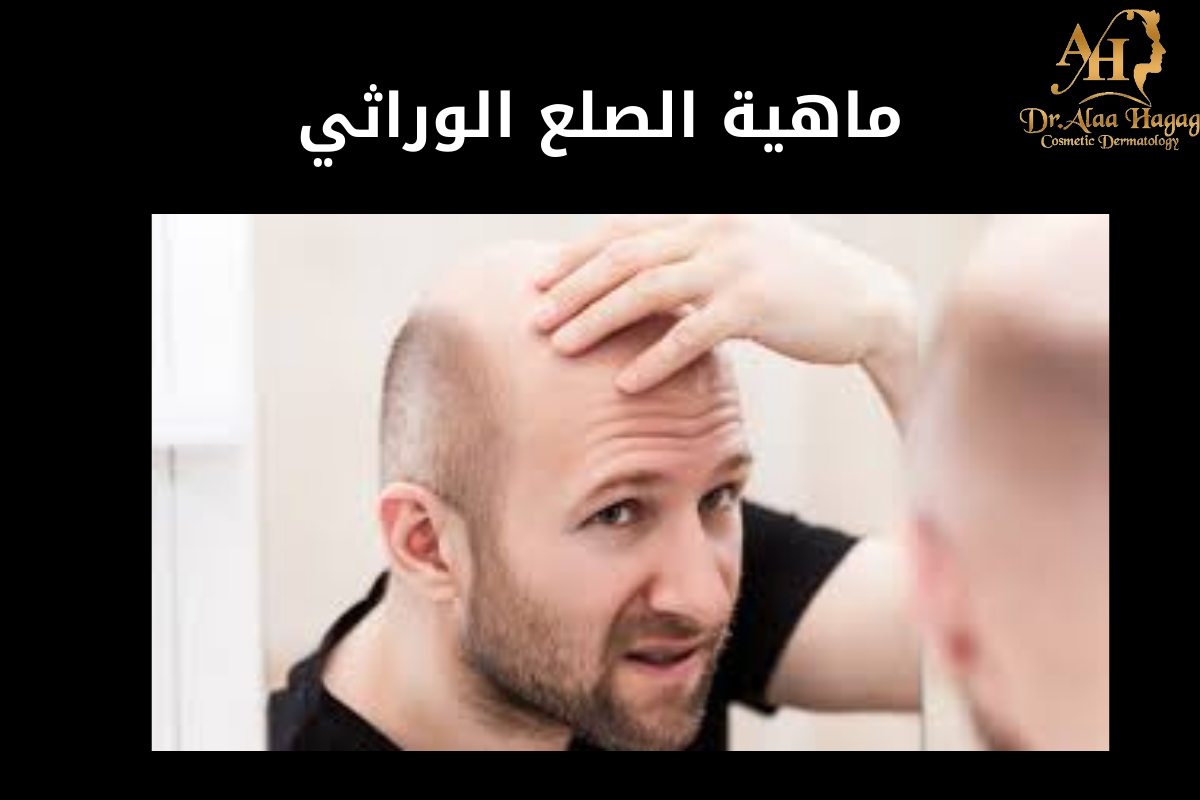 ماهية الصلع الوراثي