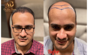 تكلفة زراعة الشعر في مصر