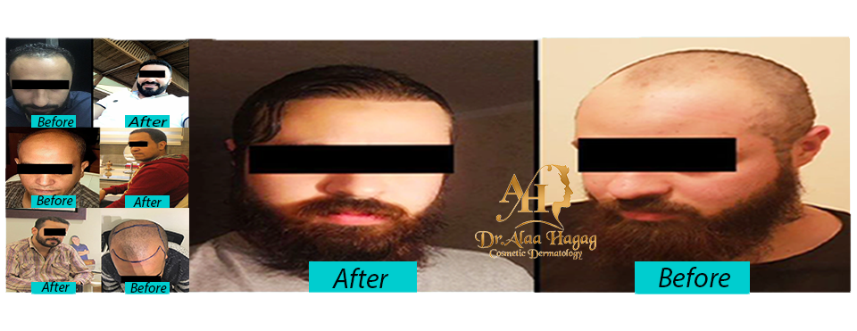 زراعة الشعر بالاقتطاف FUE