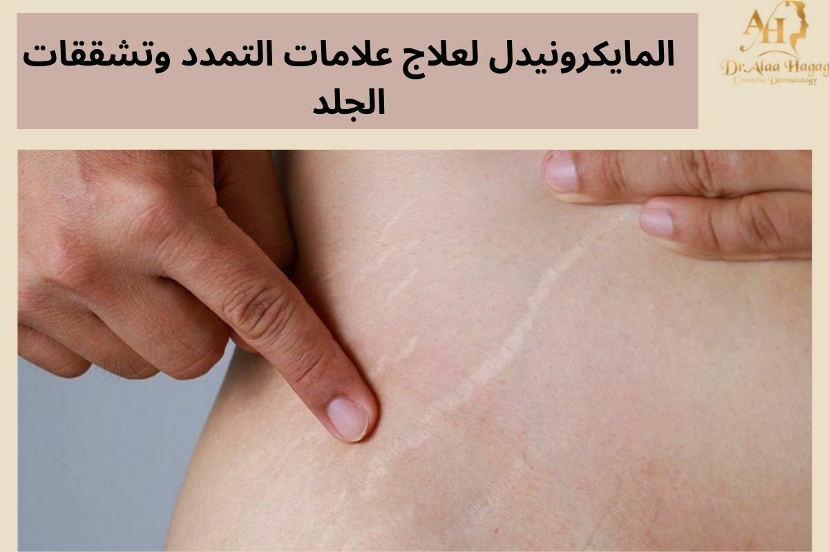 المايكرونيدل