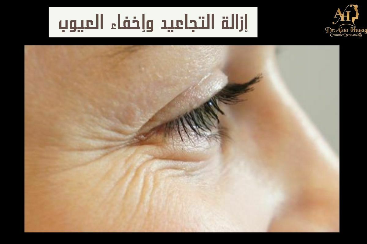 إزالة التجاعيد