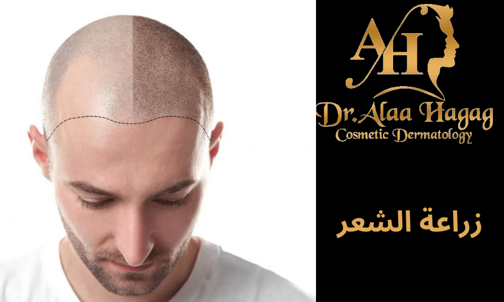 دكتور علاء حجاج لزراعة الشعر بالاقتطاف في مصر