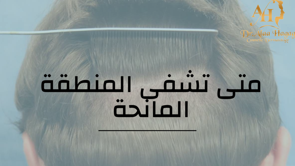 متى تشفى المنطقة المانحة