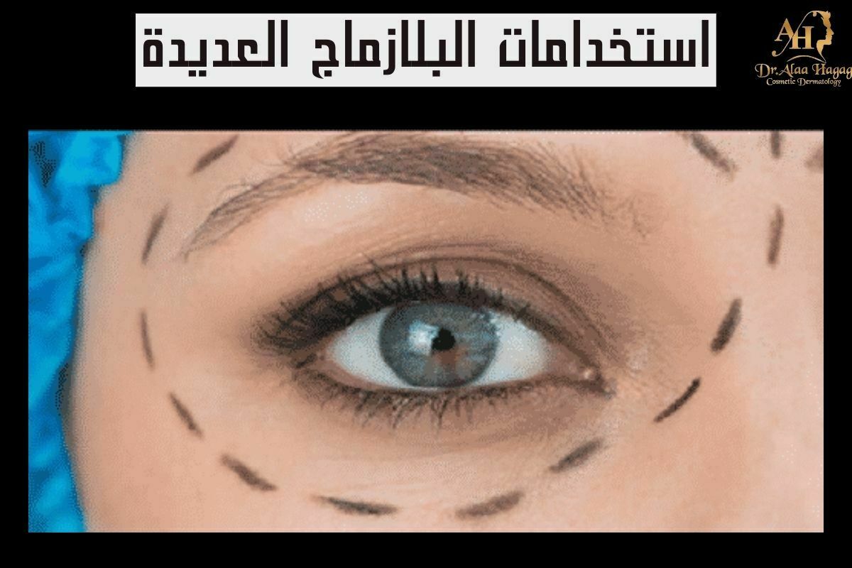 استخدامات البلازماج