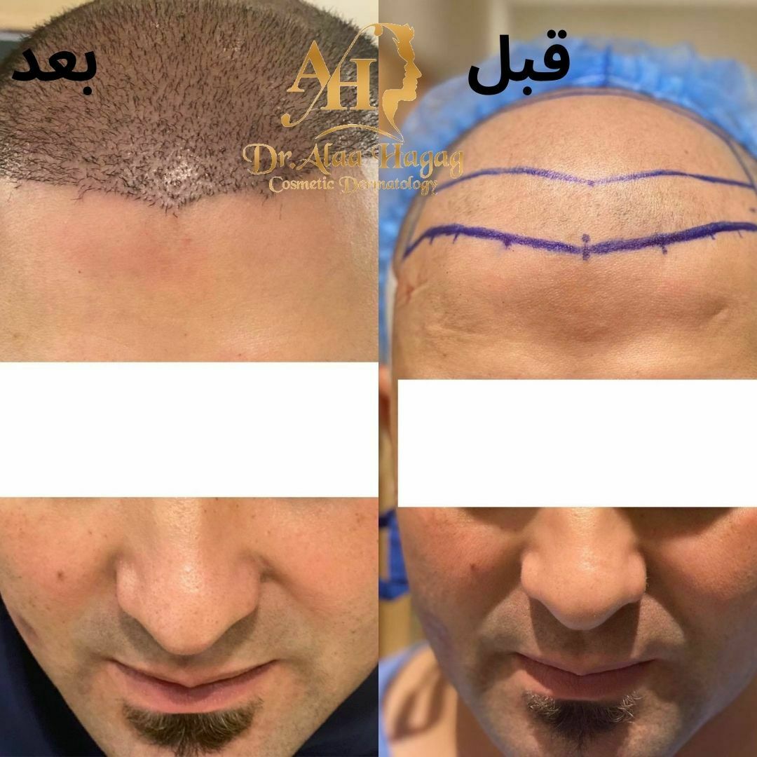 دكتور علاء حجاج لزراعة الشعر بالاقتطاف في مصر