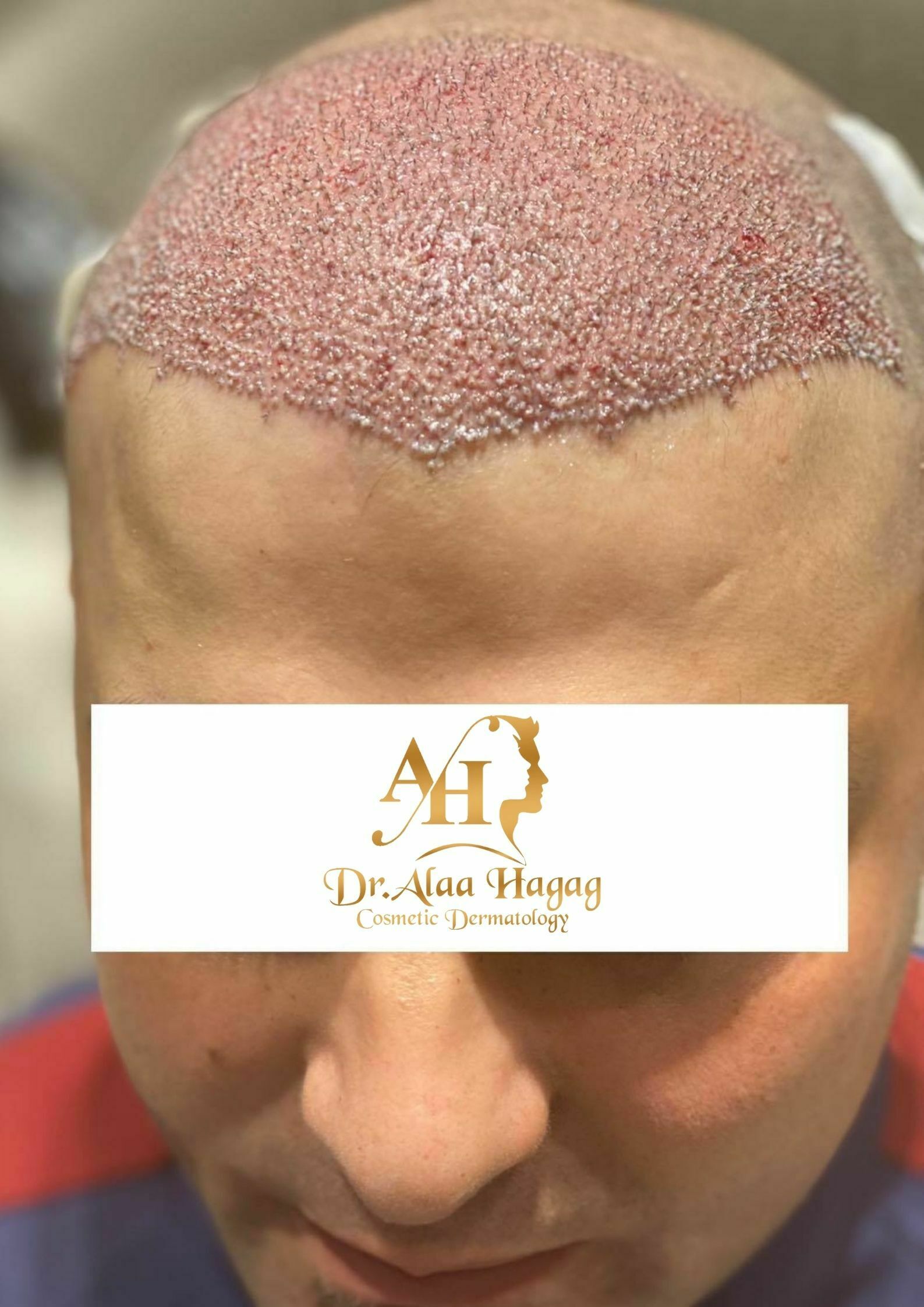 زراعة الشعر بدون حلاقة في مصر