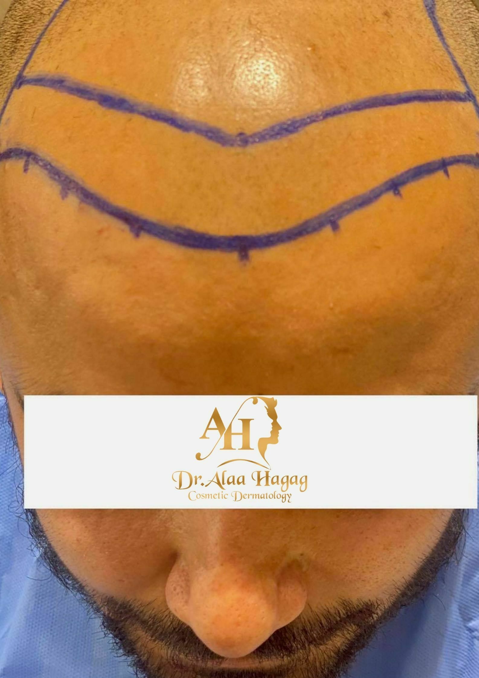 زراعة شعر في مصر