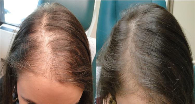 مين جرب زراعة الشعر في مصر