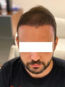  تكلفة زراعة الشعر بالجنيه المصري
