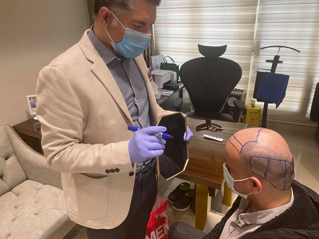 افضل دكتور زراعة الشعر في مصر
