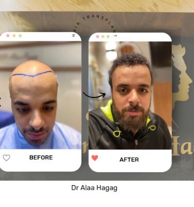 زراعة الشعر للسيدات في مصر