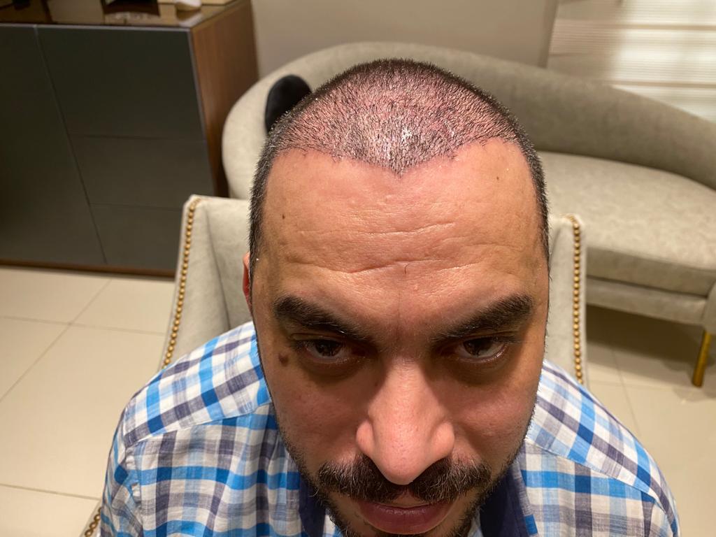 ما هي تكلفة زراعة الشعر في مصر