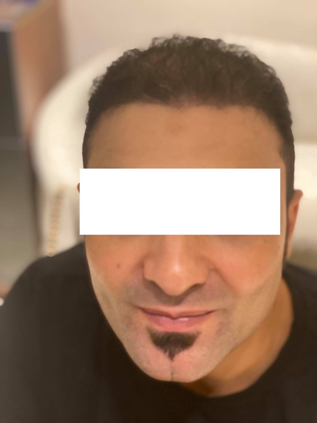 عمليات زرع الشعر في مصر وتكلفتها