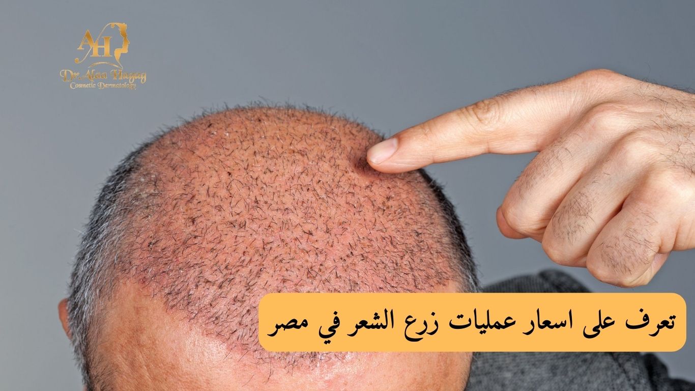 اسعار عمليات زرع الشعر