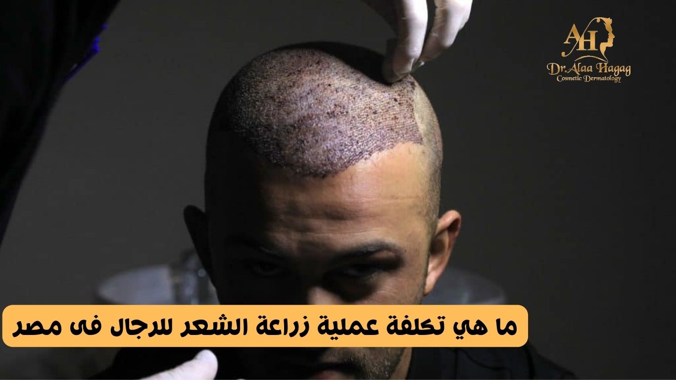 تكلفة عملية زراعة الشعر للرجال فى مصر