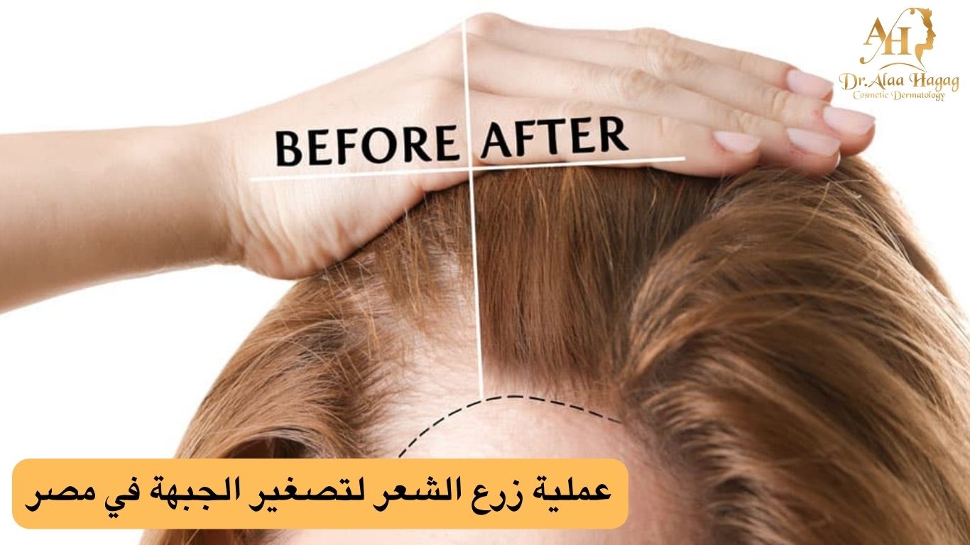 عملية زرع الشعر لتصغير الجبهة
