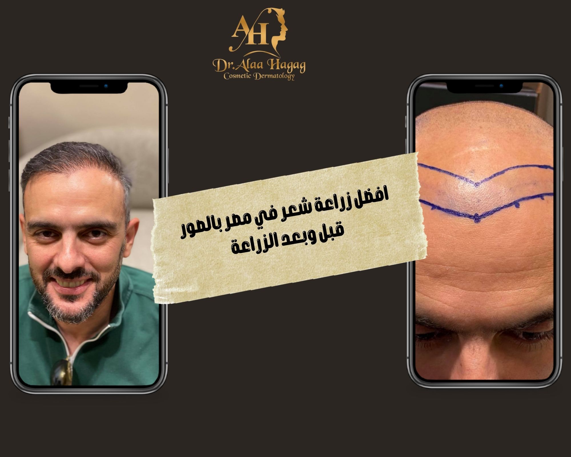 افضل زراعة شعر في مصر