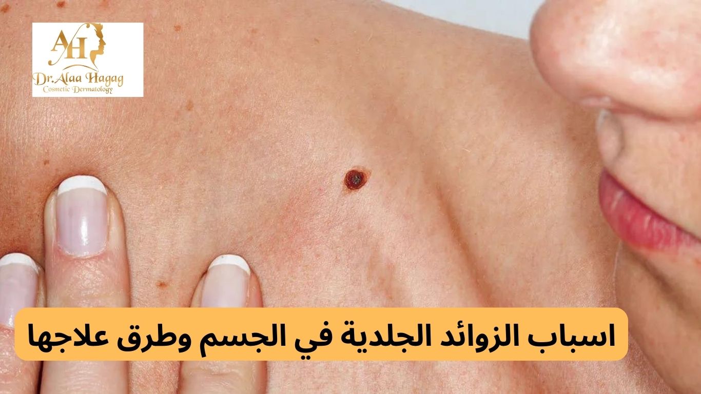 اسباب الزوائد الجلدية