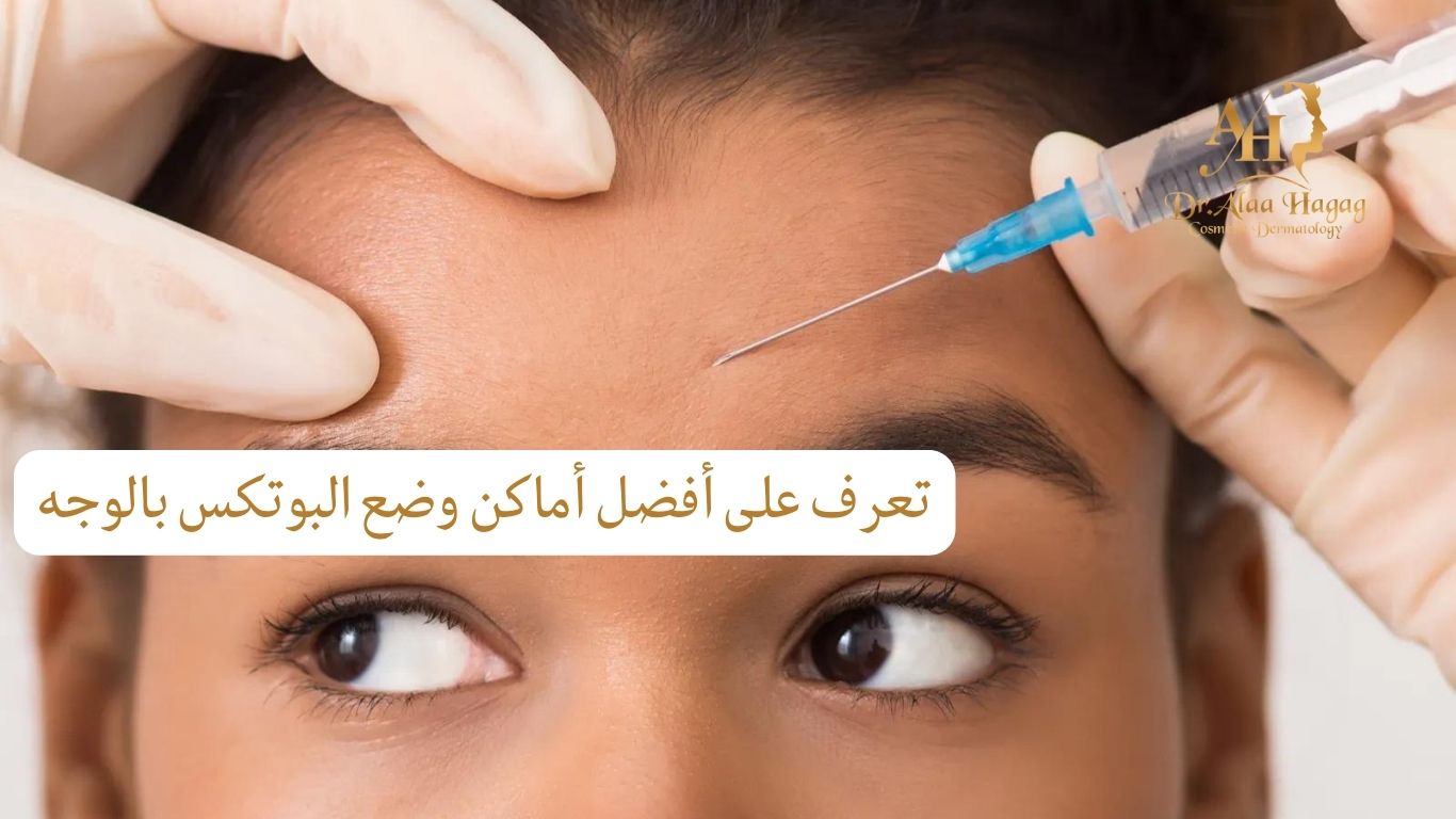 أماكن وضع البوتكس بالوجه