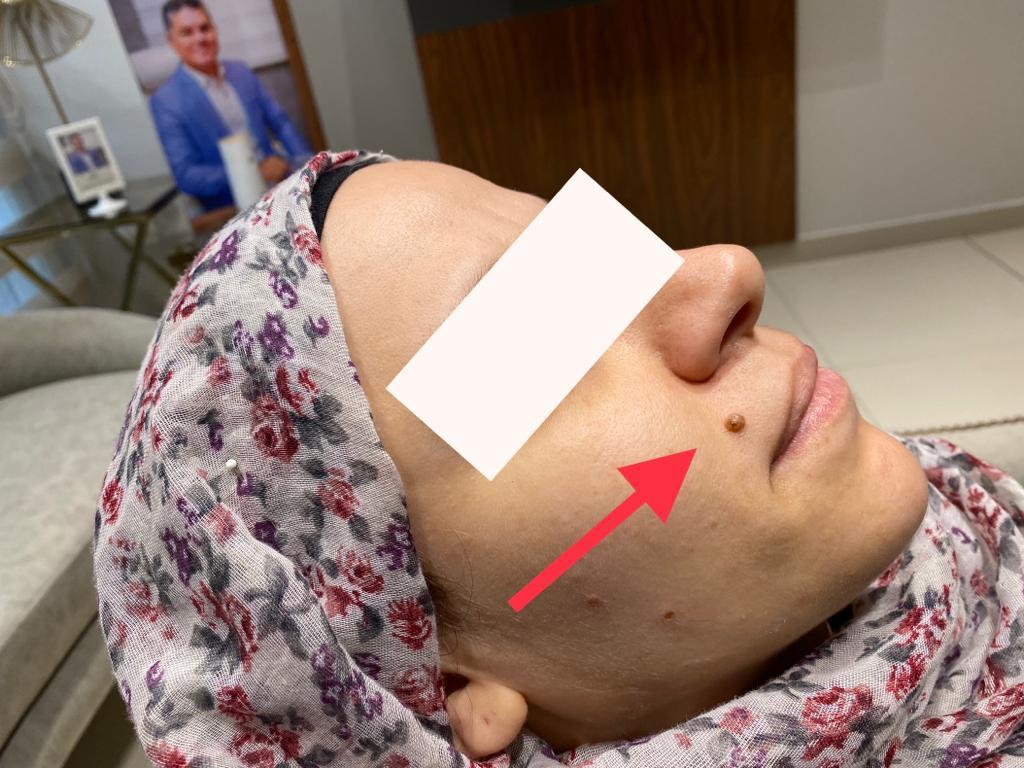 ازالة الزوائد الجلدية من الوجه