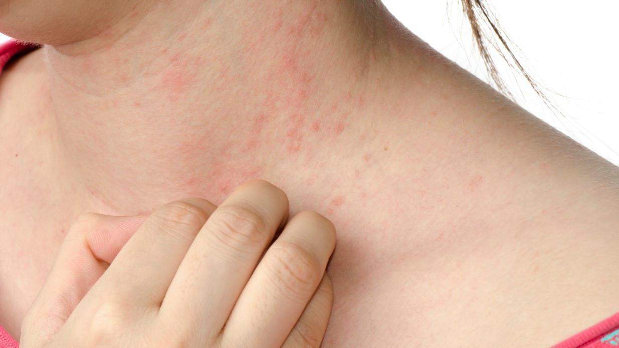 الحساسية الجلدية