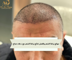 موانع زراعة الشعر