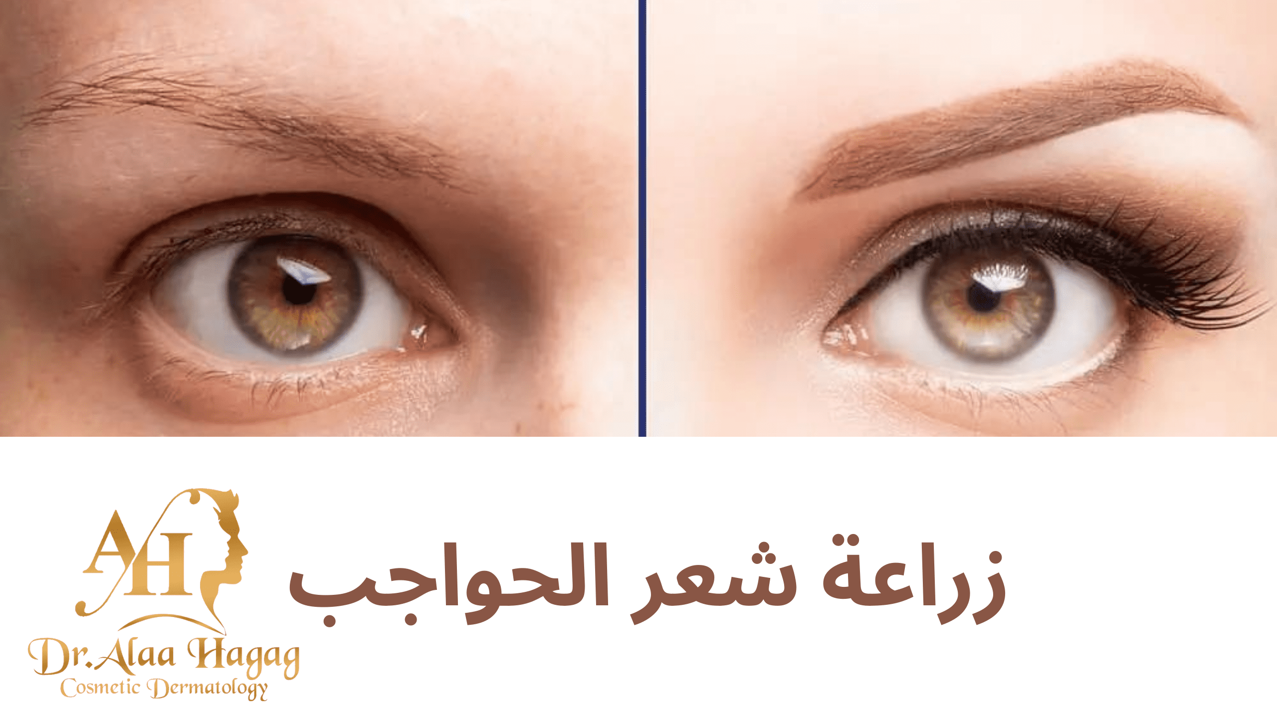 زراعة شعر الحواجب للرجال