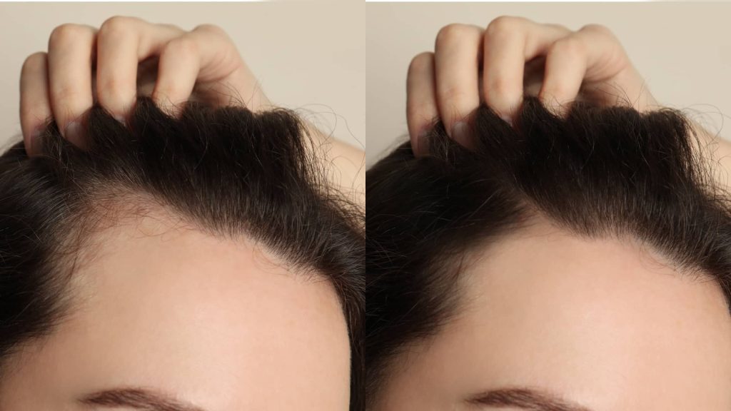 مميزات زراعة الشعر بإستخدام الخلايا الجذعية