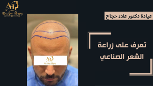 تعرف على زراعة الشعر الصناعي