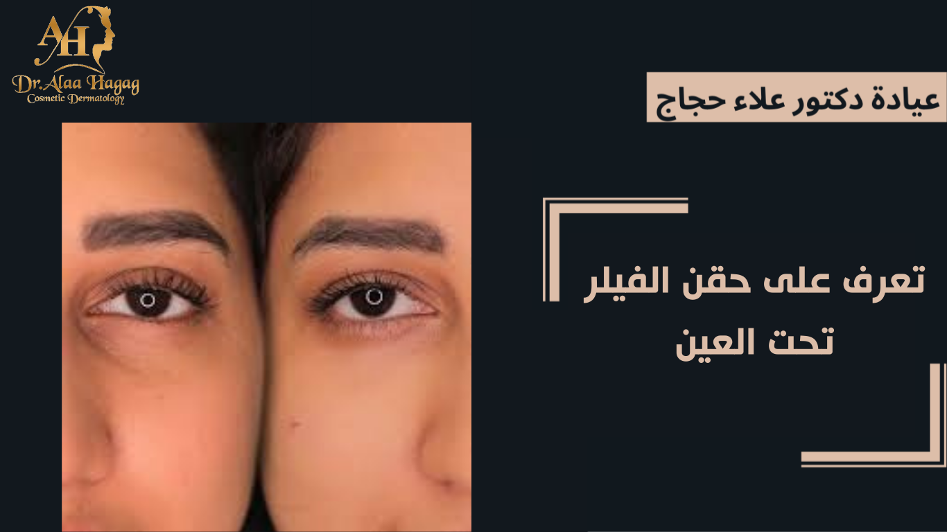 تعرف على حقن الفيلر تحت العين