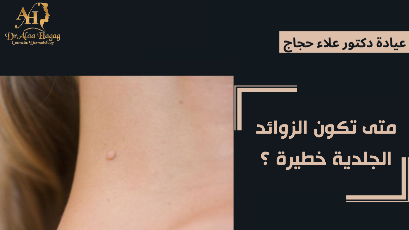 متى تكون الزوائد الجلدية خطيرة ؟
