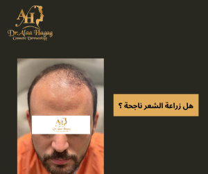 هل زراعة الشعر ناجحة؟