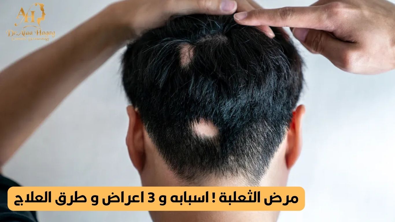 مرض الثعلبة