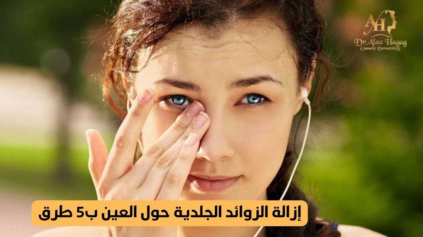 إزالة الزوائد الجلدية حول العين