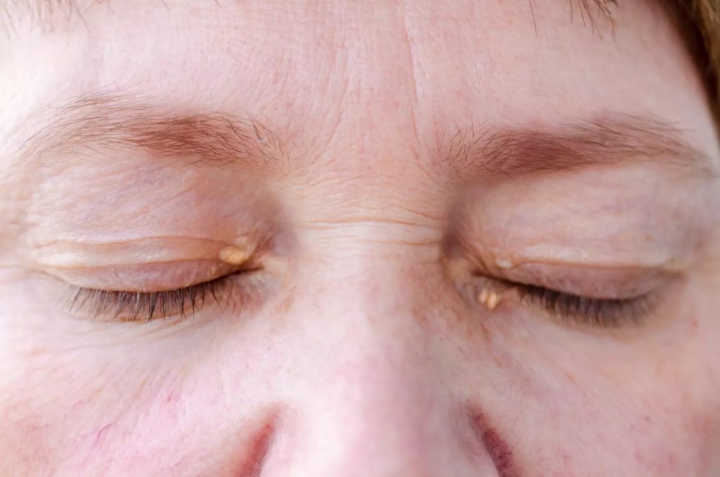 إزالة الزوائد الجلدية حول العين