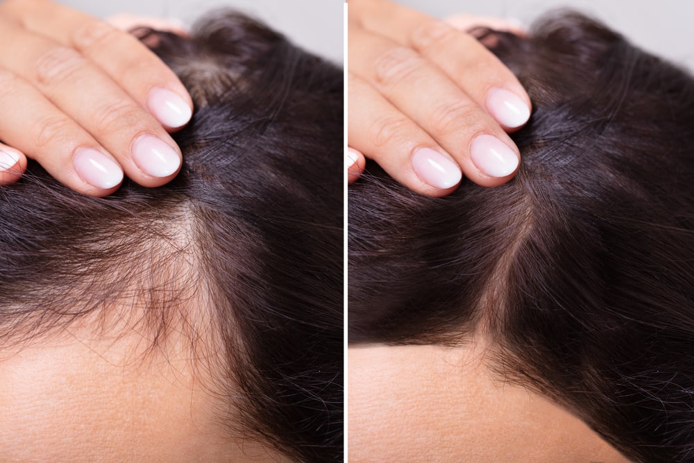 جهاز الريجينيرا لتكثيف الشعر