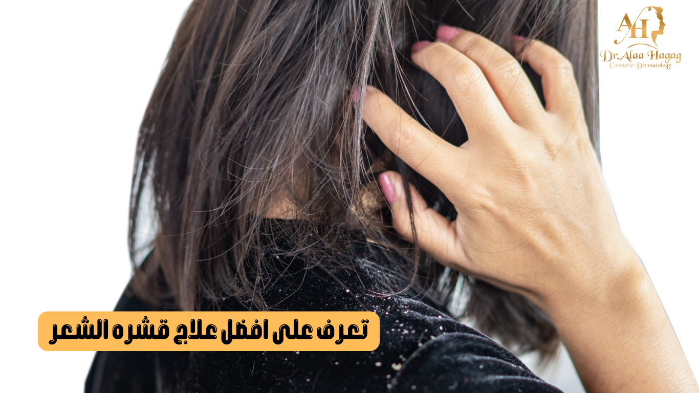 افضل علاج قشره الشعر