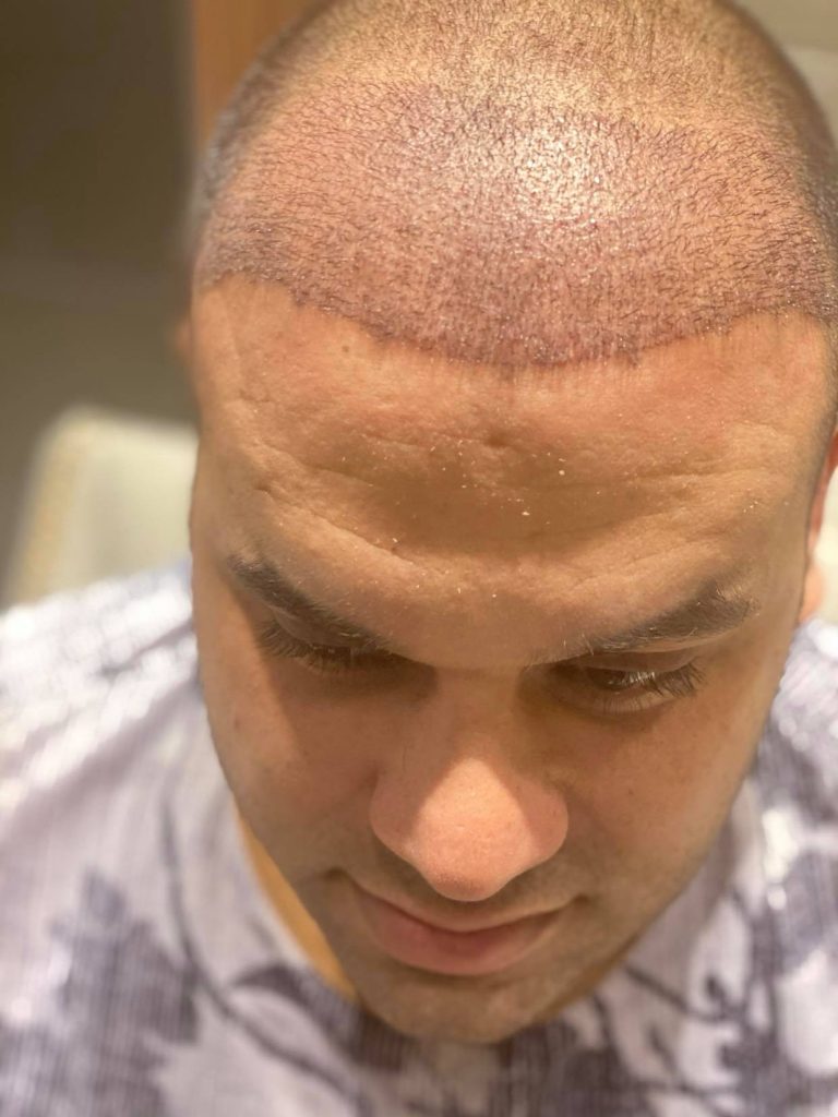 زراعة الشعر بالاقتطاف في الرياض