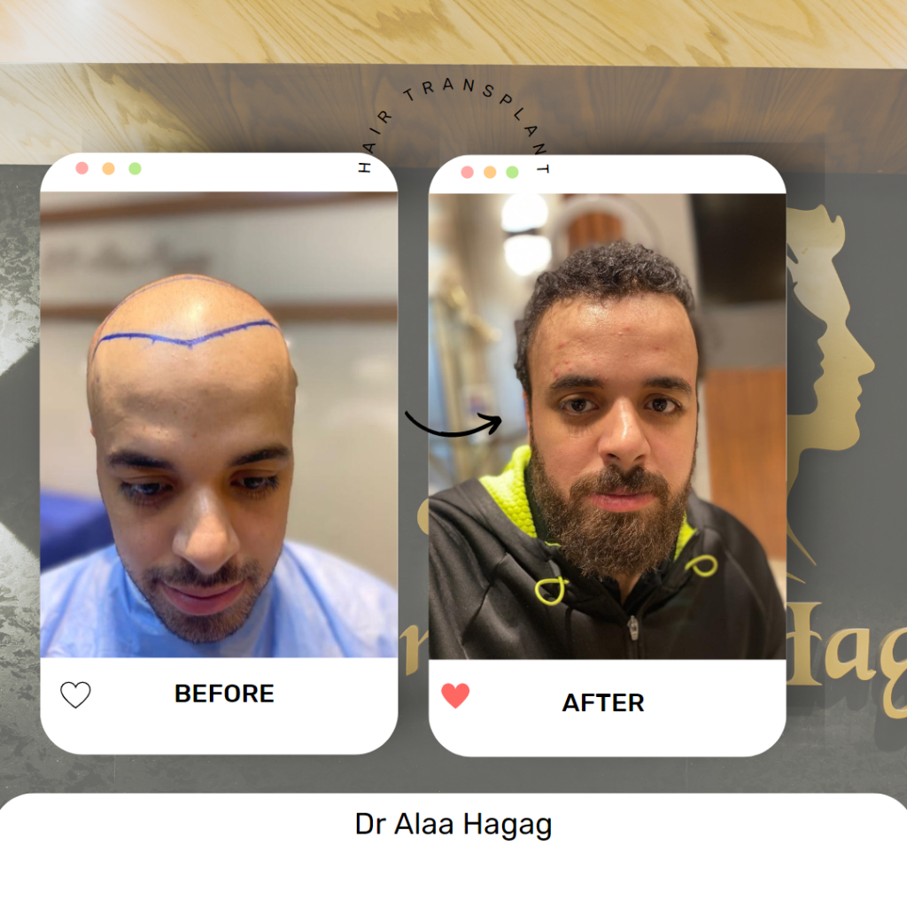 معالجة الشعر بالبلازما في الرياض