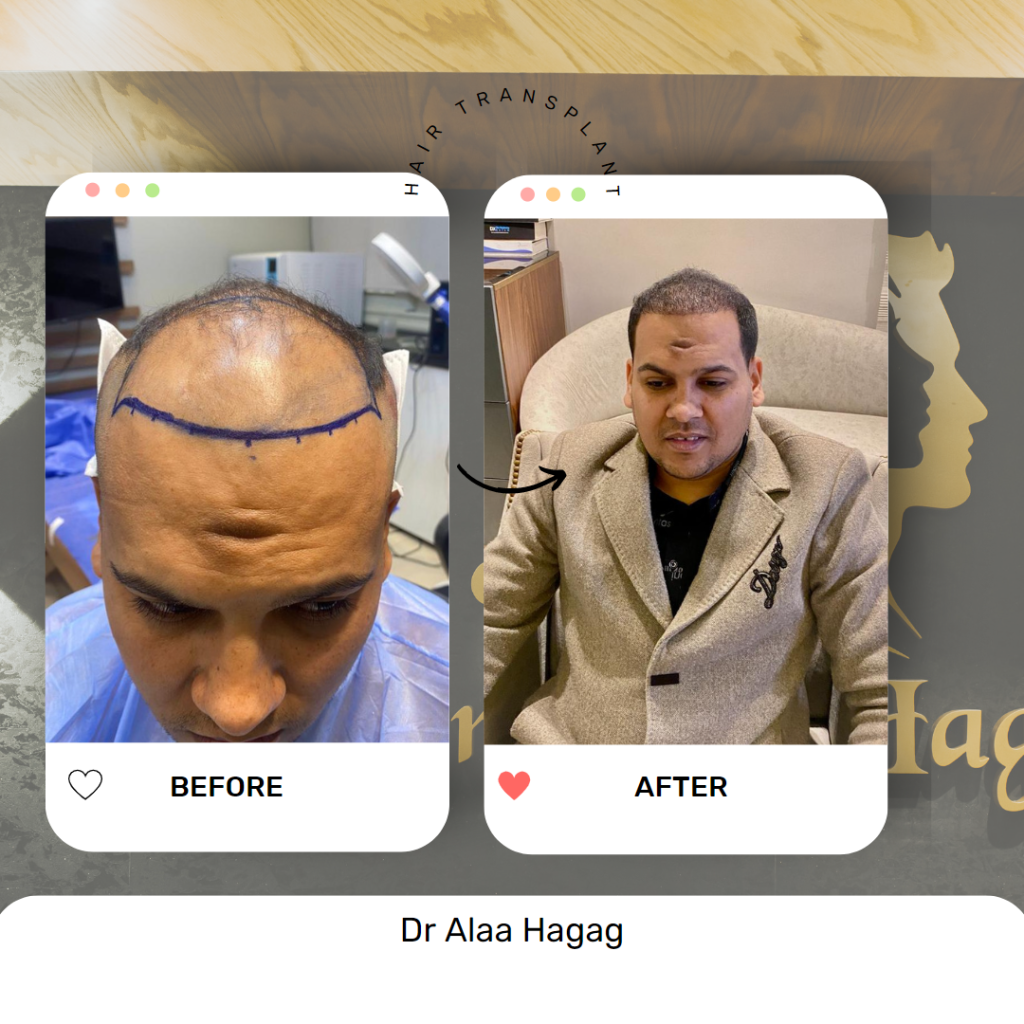 معالجة الشعر بالبلازما في الرياض