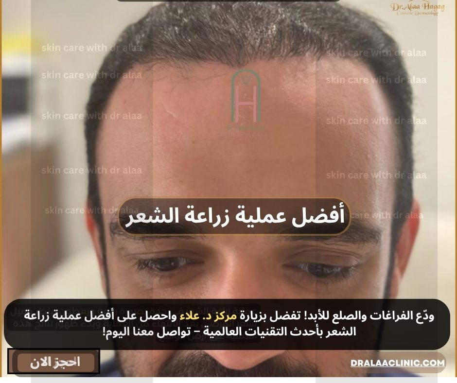 افضل عملية زراعة الشعر