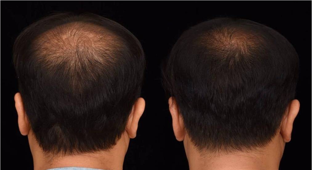 بديل زراعة الشعر