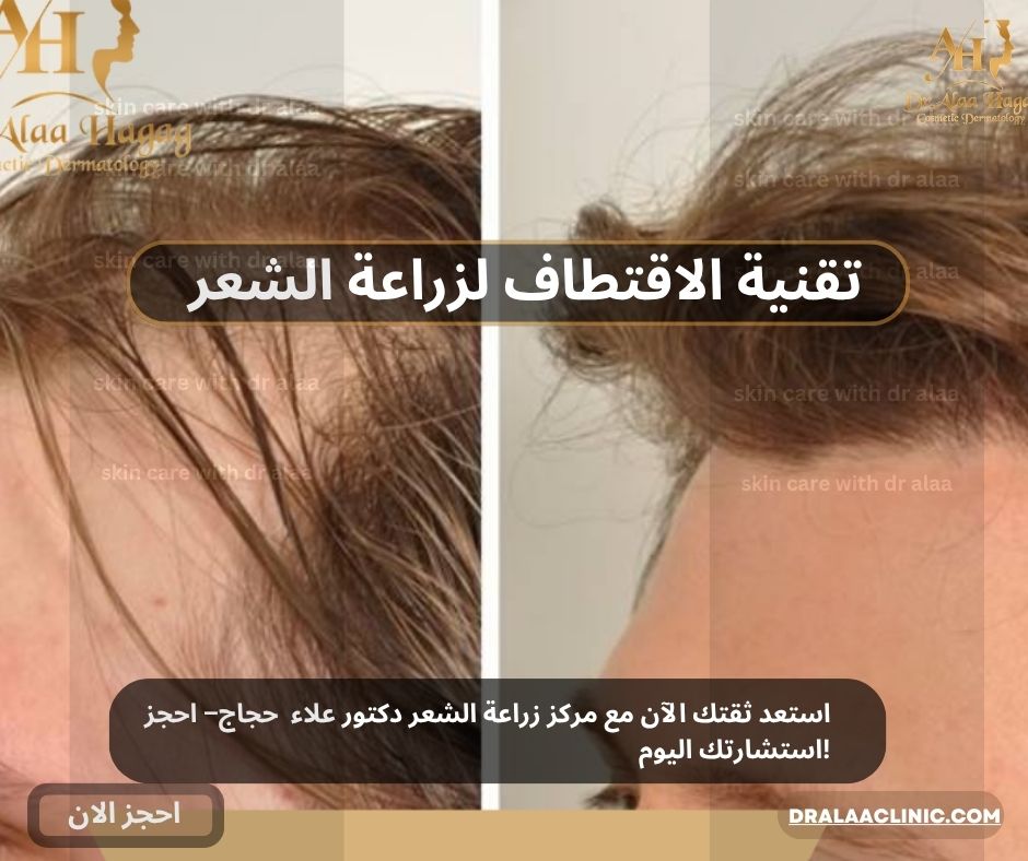تقنية الاقتطاف لزراعة الشعر