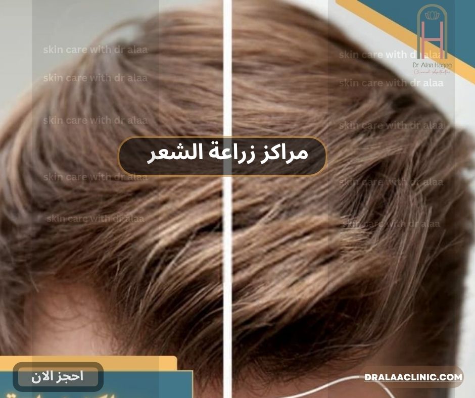 مراكز زراعة الشعر