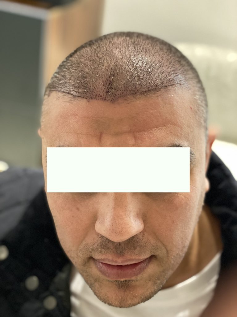 زراعة الشعر بالاقتطاف في الرياض