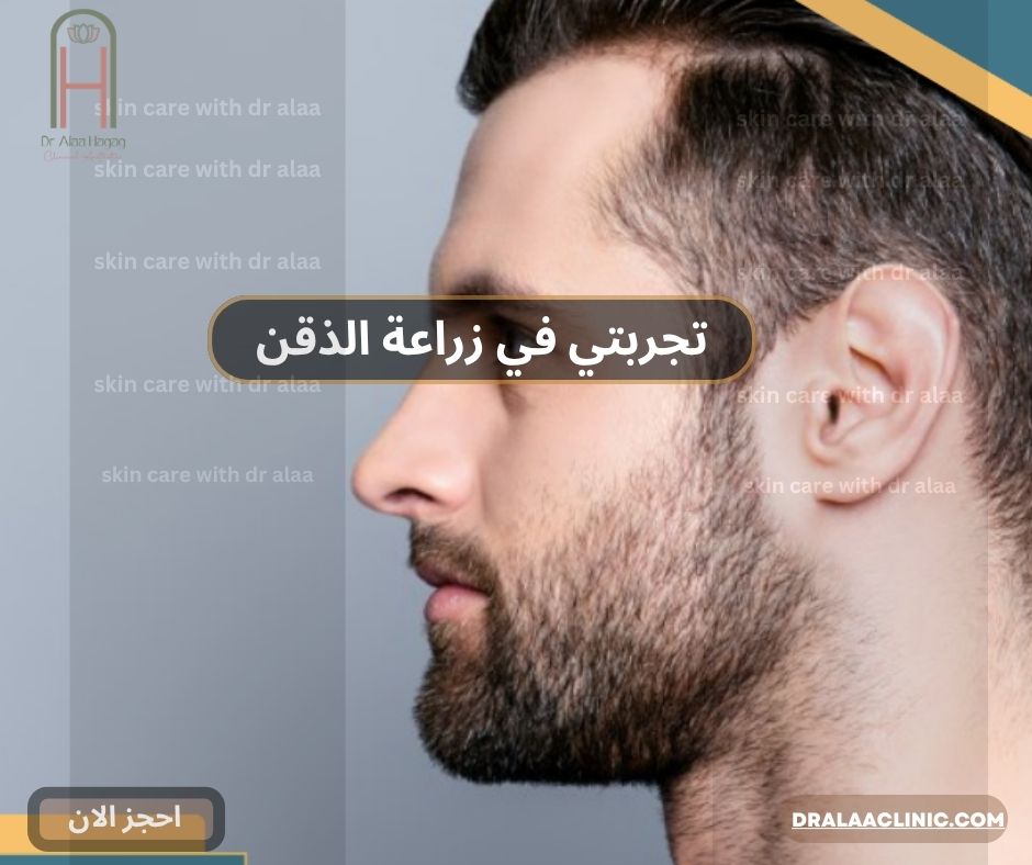 تجربتي في زراعة الذقن