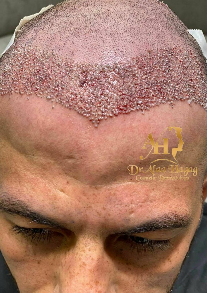 مراكز زراعة الشعر في الرياض