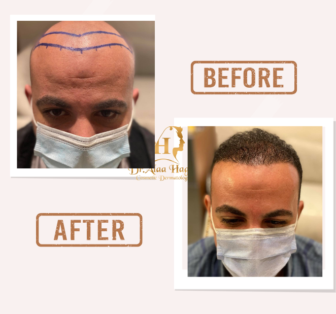 افضل طبيب زراعة الشعر في السعودية