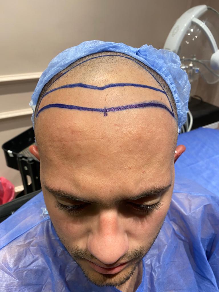 زراعة الشعر بالاقتطاف في الرياض