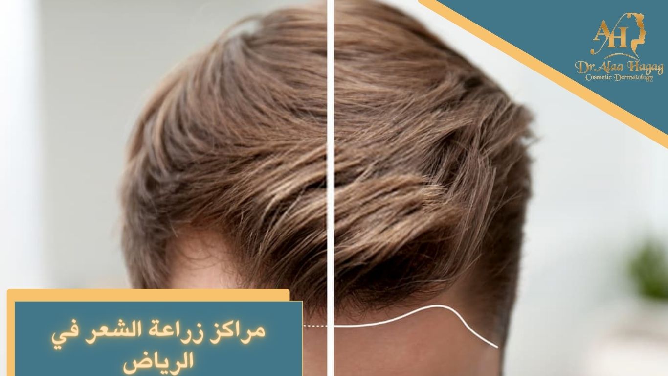 مراكز زراعة الشعر في الرياض